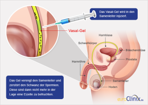 Vasalgel je polymerový gel určený ke vstříknutí do chámovodu, kde zablokuje průchod spermií do ejakulátu. Foto: Euroclinic